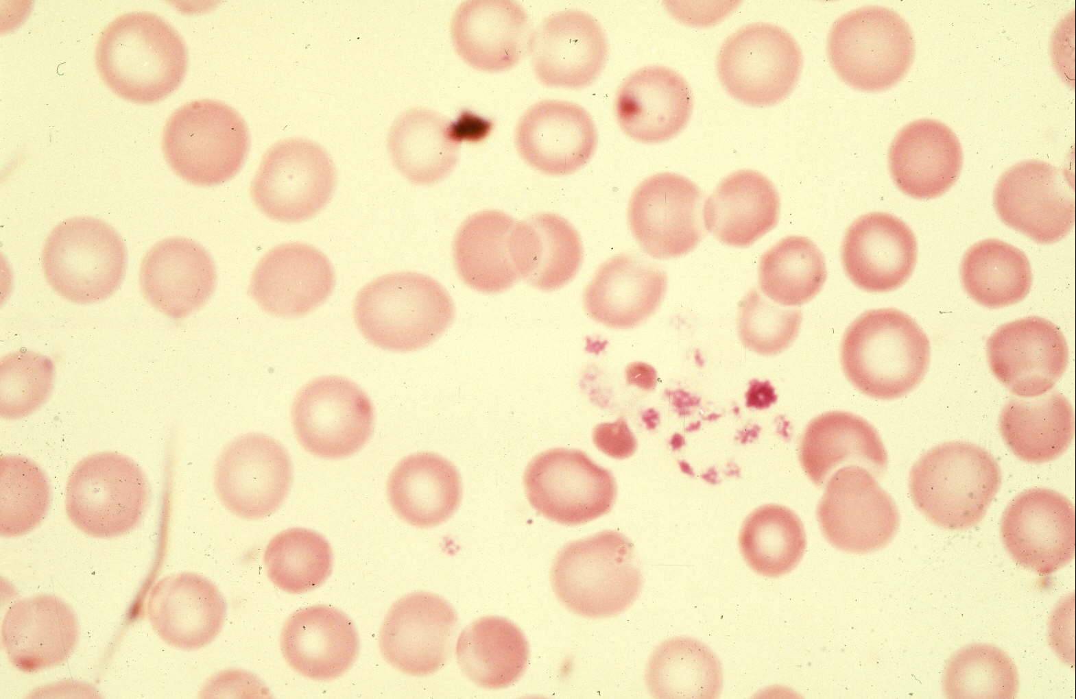 pharmacology-treatment-of-angina-part-iii-platelets-and-primary